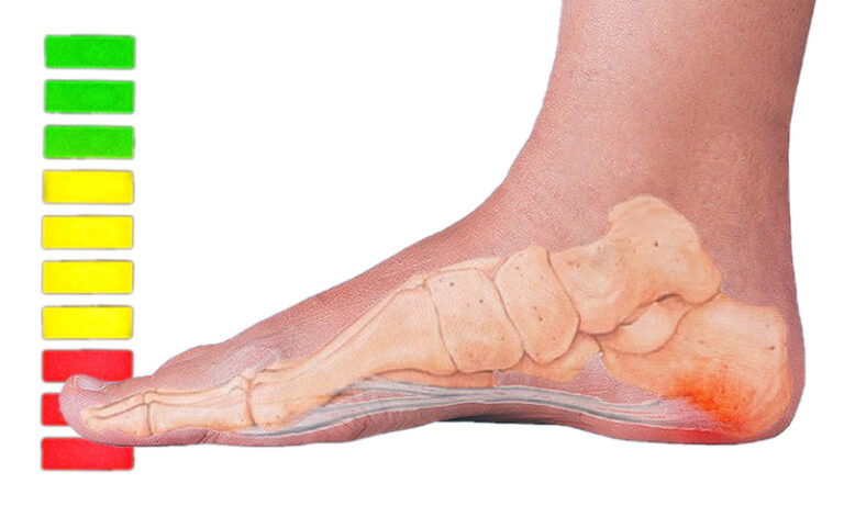 How to Cure Plantar Fasciitis in One Week